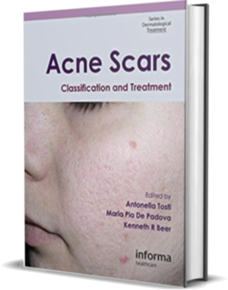 Acne Scars: Classification and Treatment